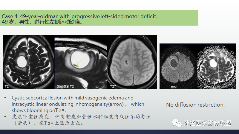 影像PPT - 【PPT】脑肿瘤和肿瘤样病变中的遗漏、误解和误导性影像征象-14