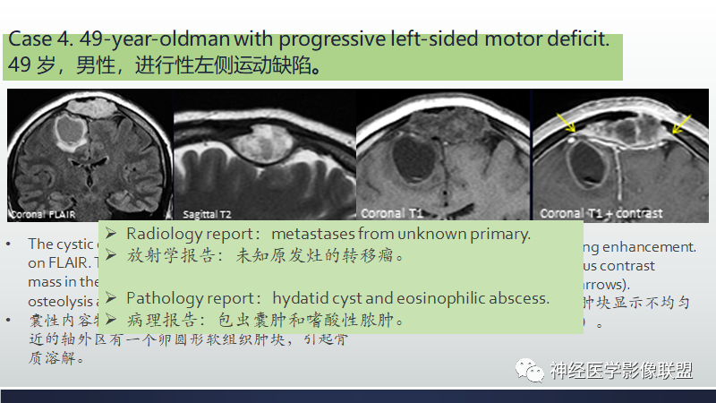 影像PPT - 【PPT】脑肿瘤和肿瘤样病变中的遗漏、误解和误导性影像征象-15