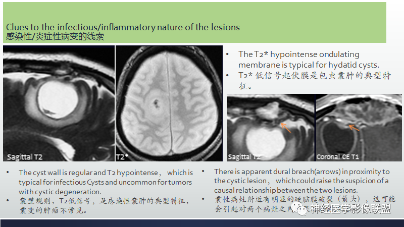 影像PPT - 【PPT】脑肿瘤和肿瘤样病变中的遗漏、误解和误导性影像征象-17