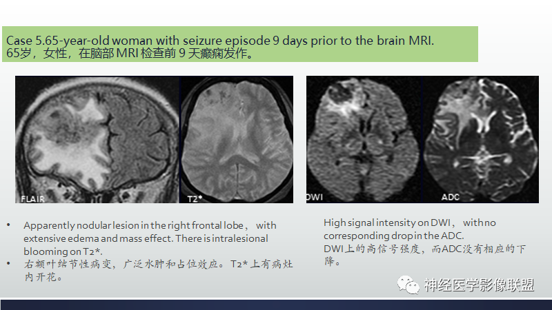 影像PPT - 【PPT】脑肿瘤和肿瘤样病变中的遗漏、误解和误导性影像征象-19