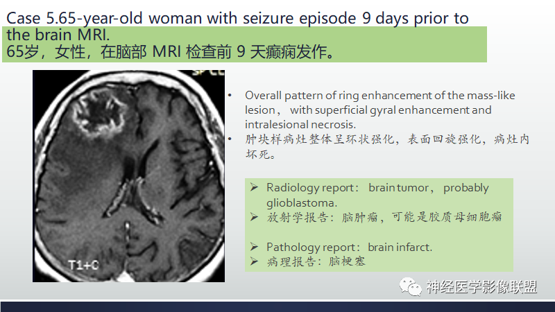 影像PPT - 【PPT】脑肿瘤和肿瘤样病变中的遗漏、误解和误导性影像征象-20