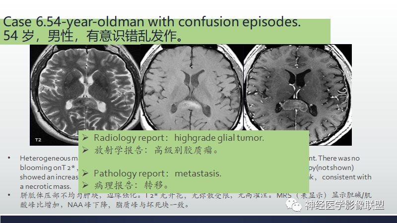 影像PPT - 【PPT】脑肿瘤和肿瘤样病变中的遗漏、误解和误导性影像征象-24