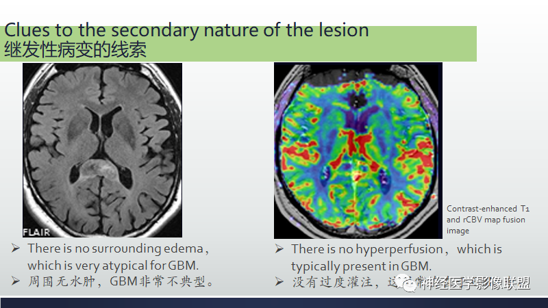 影像PPT - 【PPT】脑肿瘤和肿瘤样病变中的遗漏、误解和误导性影像征象-26