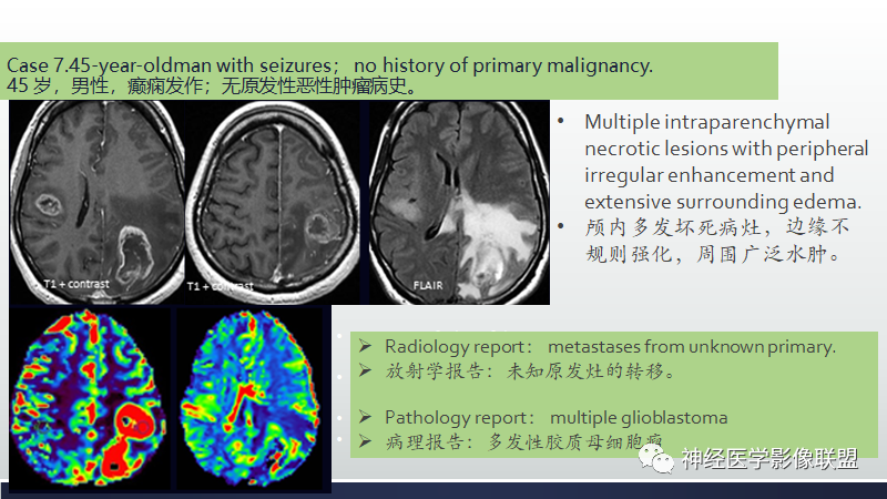 影像PPT - 【PPT】脑肿瘤和肿瘤样病变中的遗漏、误解和误导性影像征象-28