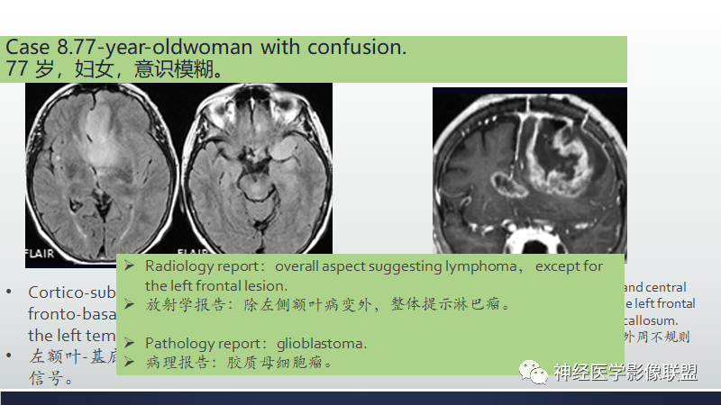 影像PPT - 【PPT】脑肿瘤和肿瘤样病变中的遗漏、误解和误导性影像征象-32
