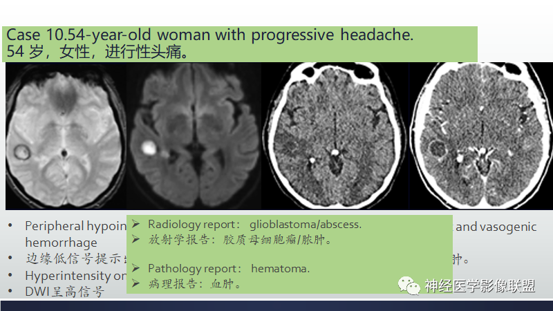 影像PPT - 【PPT】脑肿瘤和肿瘤样病变中的遗漏、误解和误导性影像征象-39