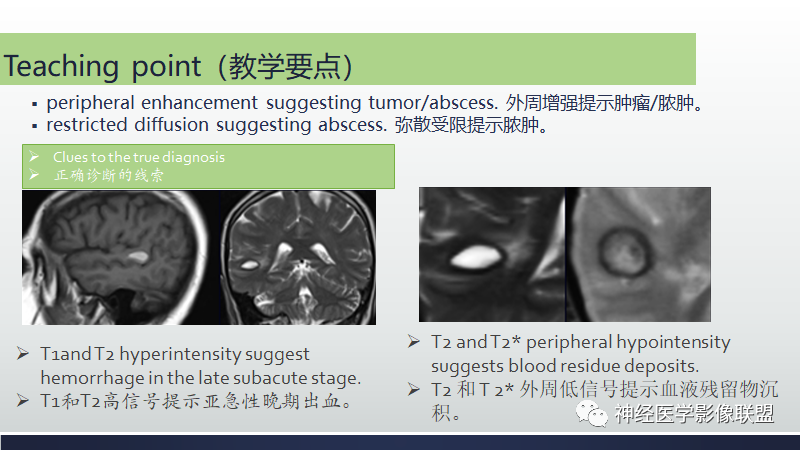 影像PPT - 【PPT】脑肿瘤和肿瘤样病变中的遗漏、误解和误导性影像征象-40