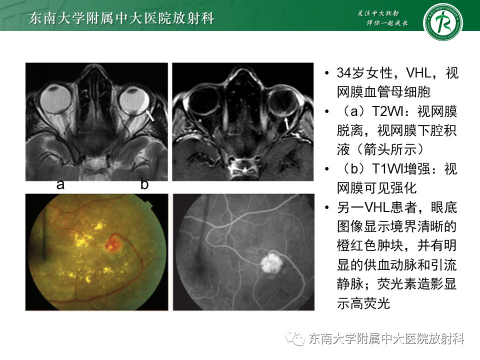 影像PPT - 【PPT】VHL综合征-10