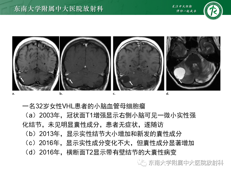 影像PPT - 【PPT】VHL综合征-12