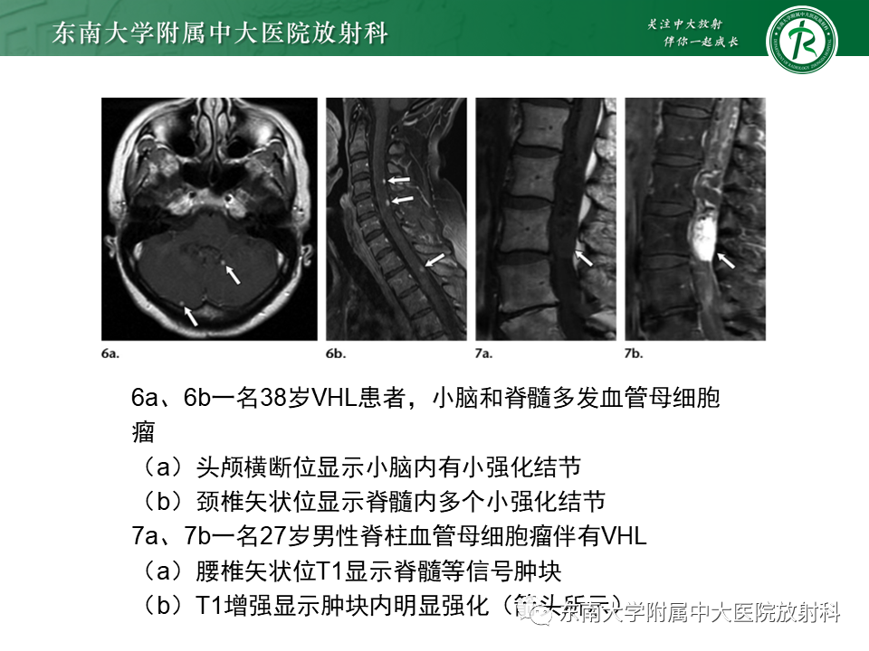 影像PPT - 【PPT】VHL综合征-13