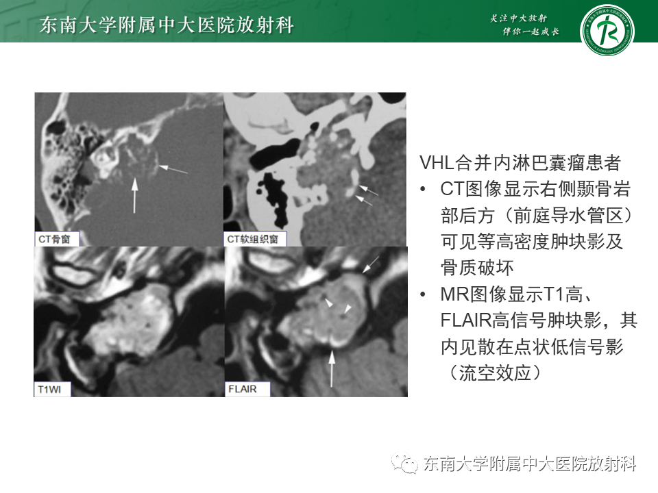 影像PPT - 【PPT】VHL综合征-15