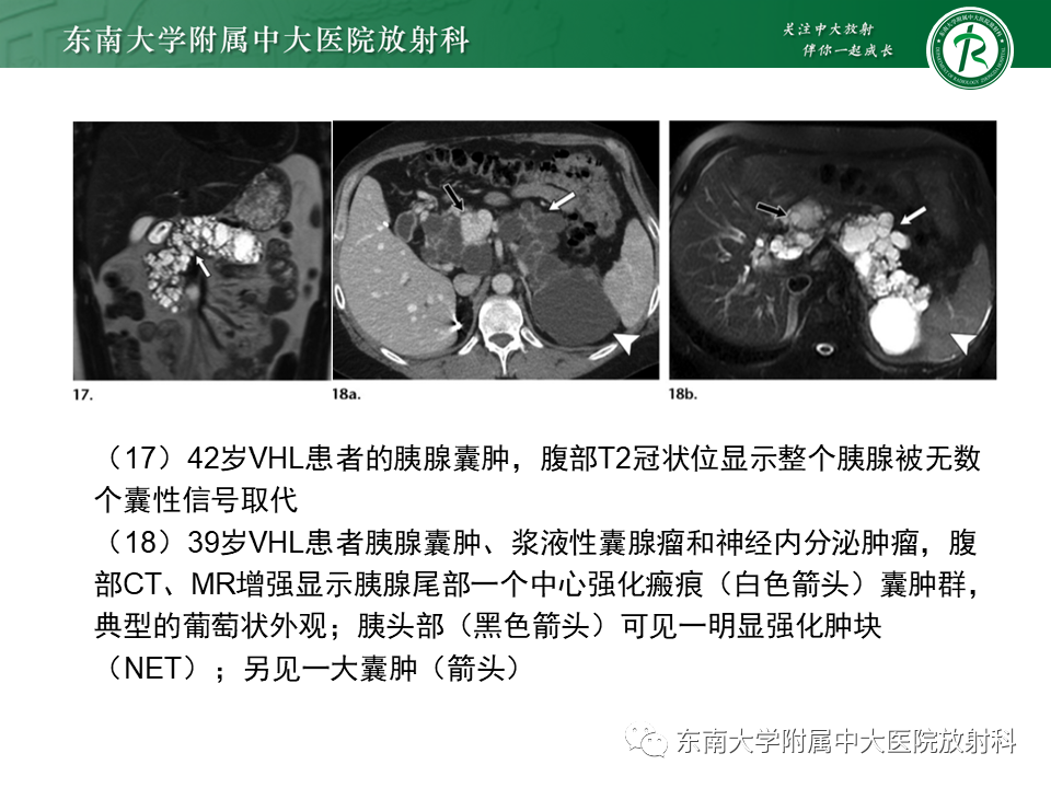 影像PPT - 【PPT】VHL综合征-18
