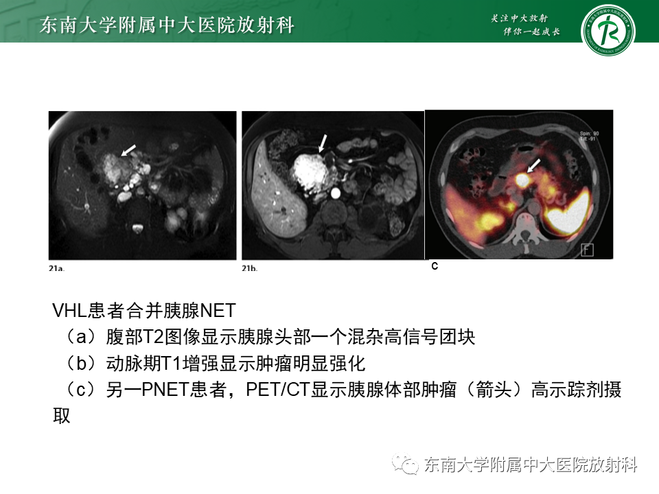 影像PPT - 【PPT】VHL综合征-19