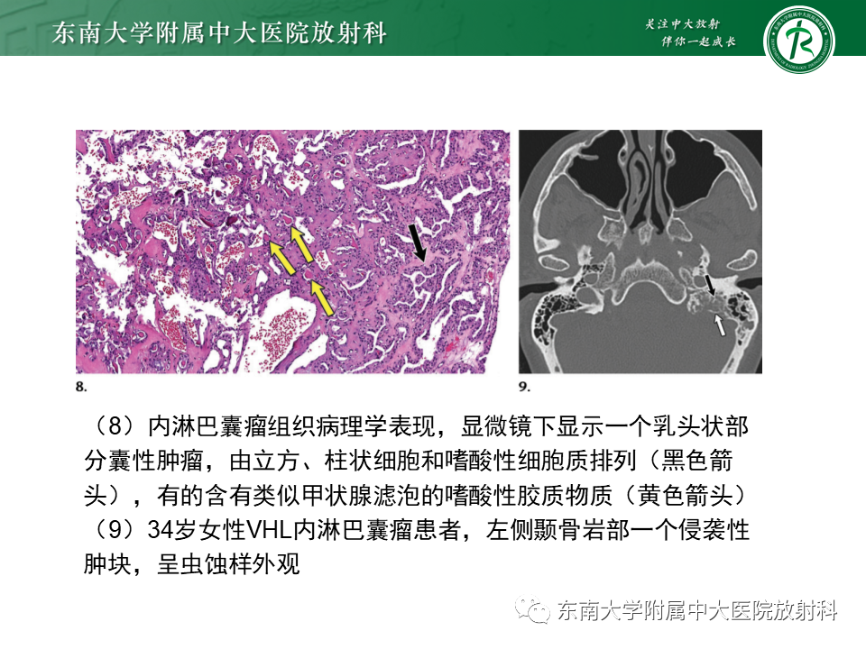 影像PPT - 【PPT】VHL综合征-16