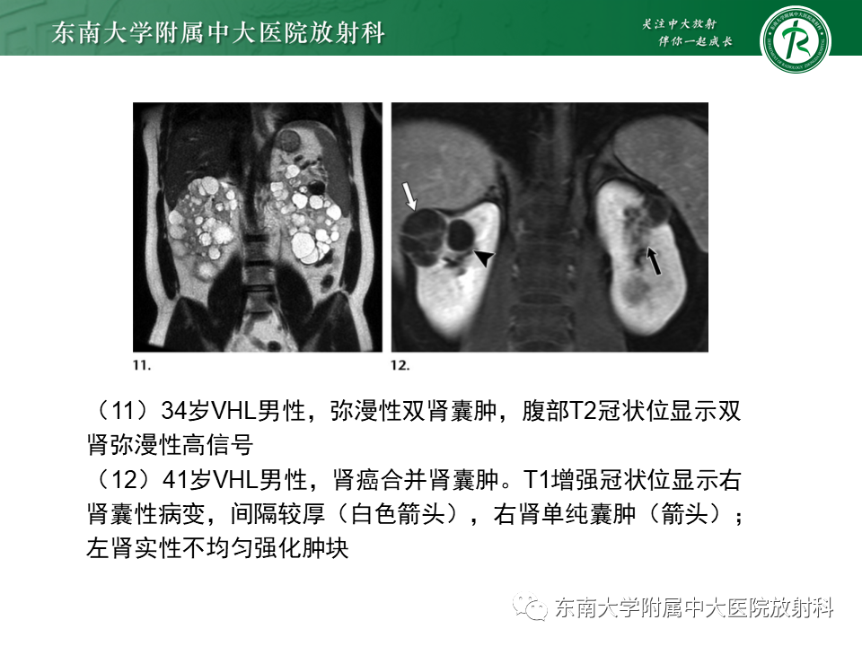 影像PPT - 【PPT】VHL综合征-21