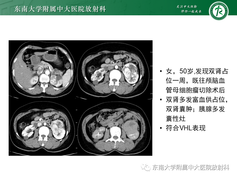 影像PPT - 【PPT】VHL综合征-22