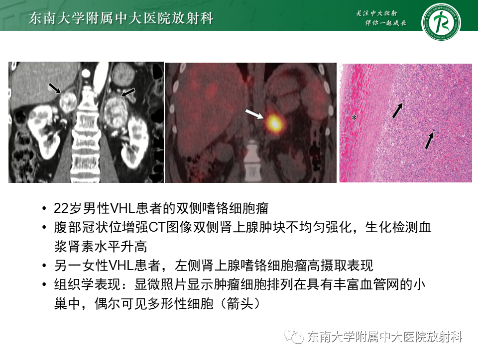 影像PPT - 【PPT】VHL综合征-25