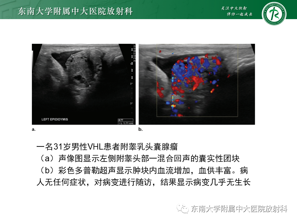 影像PPT - 【PPT】VHL综合征-27
