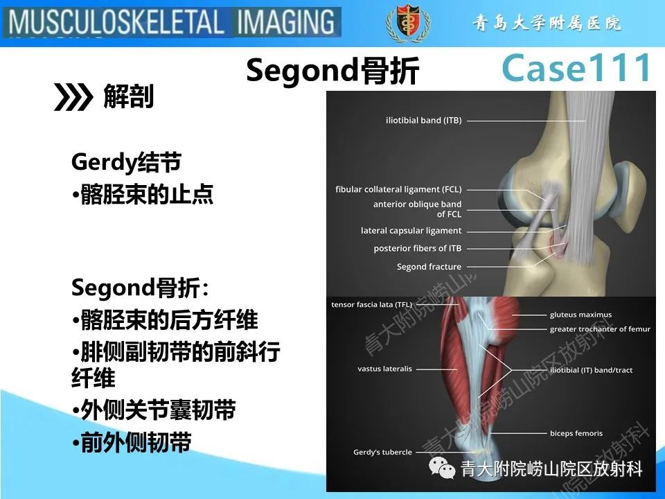 影像PPT - 【PPT】Segond 骨折-6