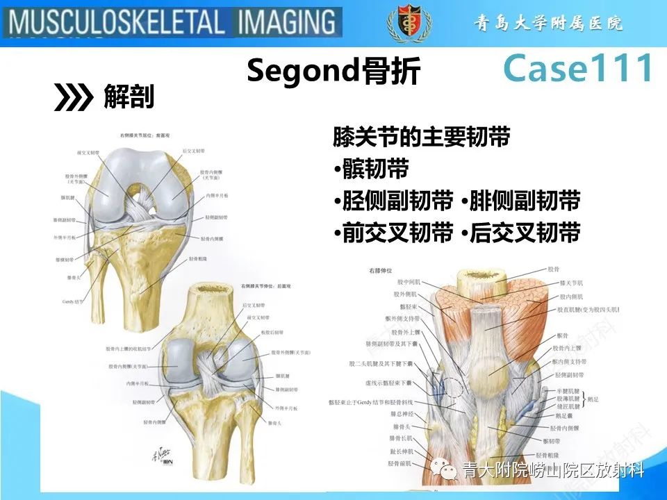 影像PPT - 【PPT】Segond 骨折-5