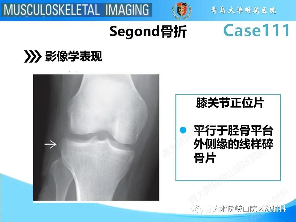 影像PPT - 【PPT】Segond 骨折-9