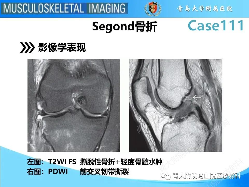 影像PPT - 【PPT】Segond 骨折-10