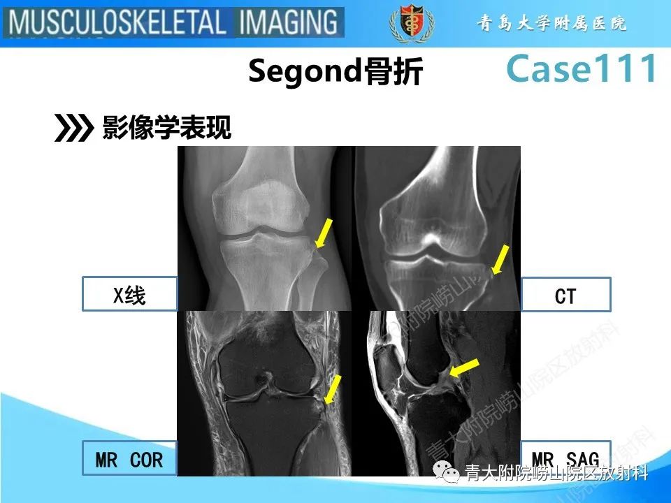影像PPT - 【PPT】Segond 骨折-11