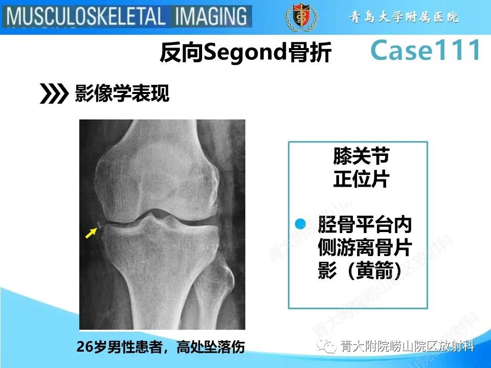 影像PPT - 【PPT】Segond 骨折-13