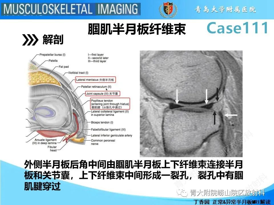 影像PPT - 【PPT】Segond 骨折-19