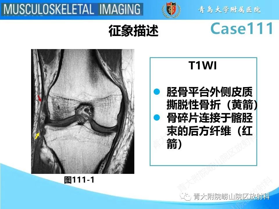 影像PPT - 【PPT】Segond 骨折-25