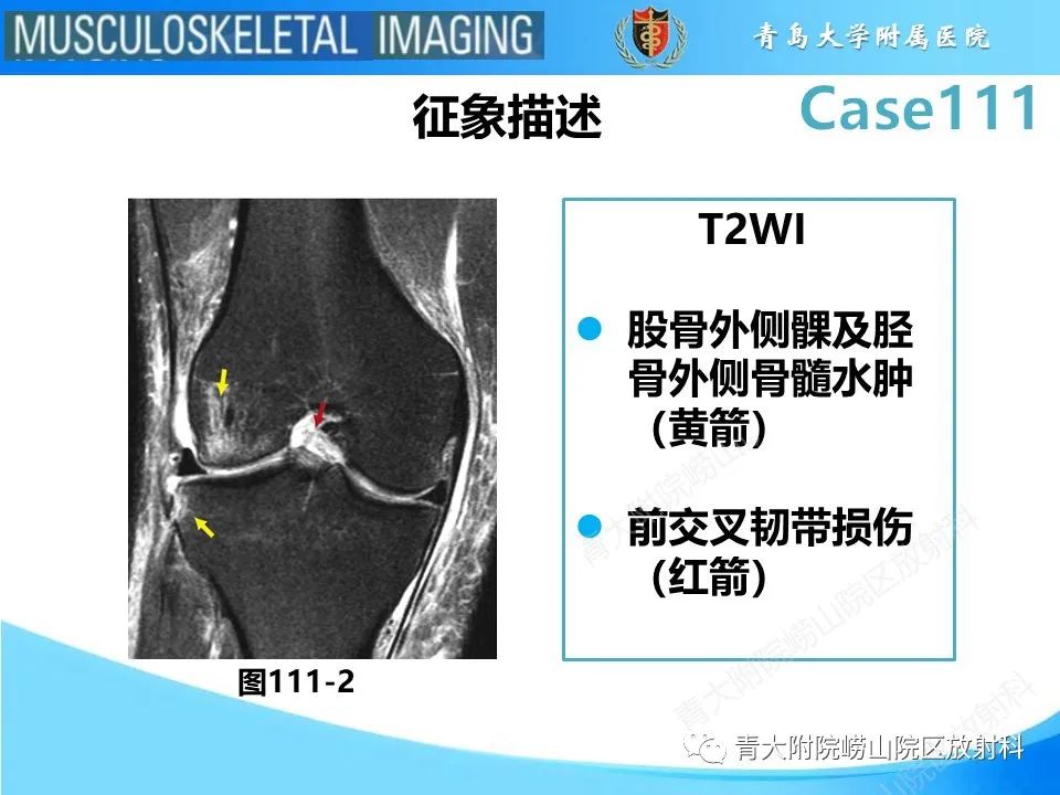 影像PPT - 【PPT】Segond 骨折-26