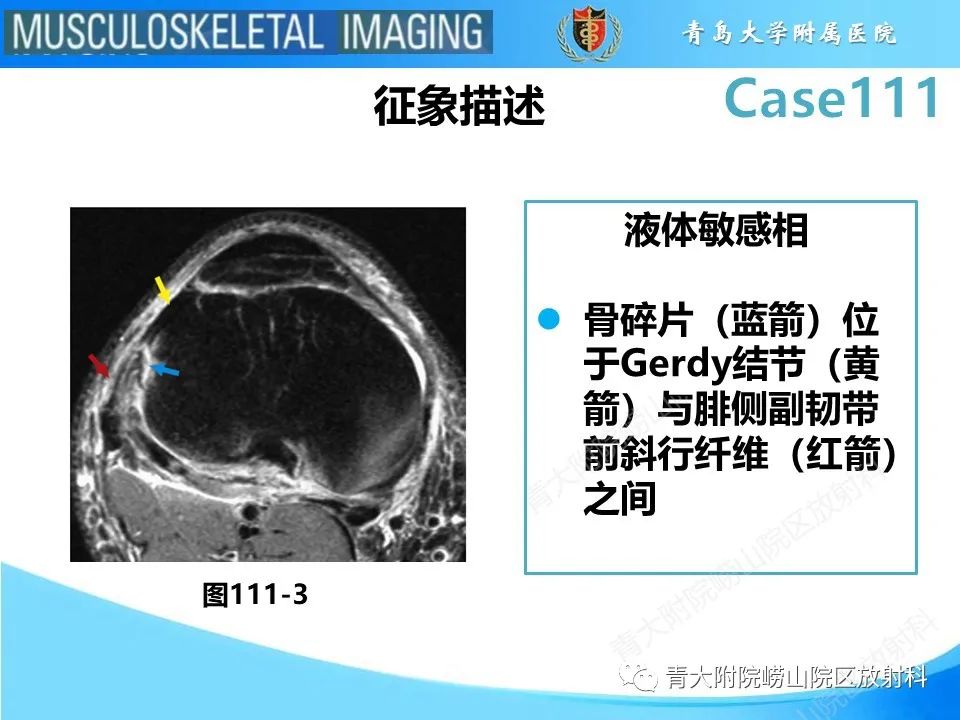 影像PPT - 【PPT】Segond 骨折-27