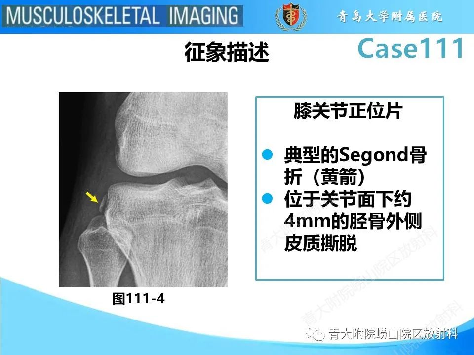 影像PPT - 【PPT】Segond 骨折-28