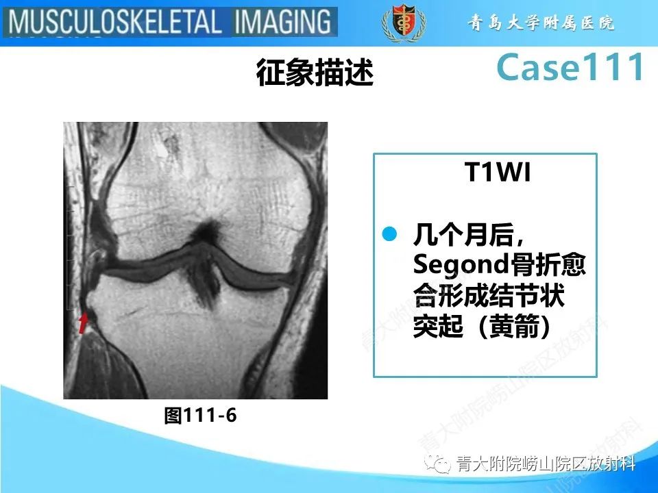 影像PPT - 【PPT】Segond 骨折-30