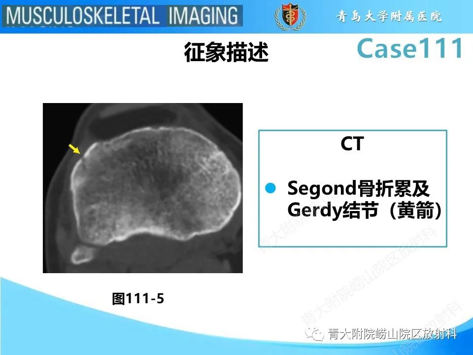 影像PPT - 【PPT】Segond 骨折-29