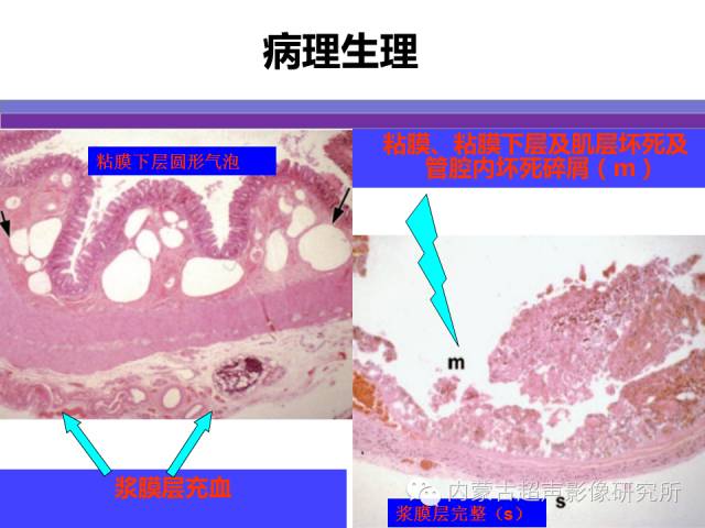 影像PPT - 【PPT】坏死性小肠结肠炎-4