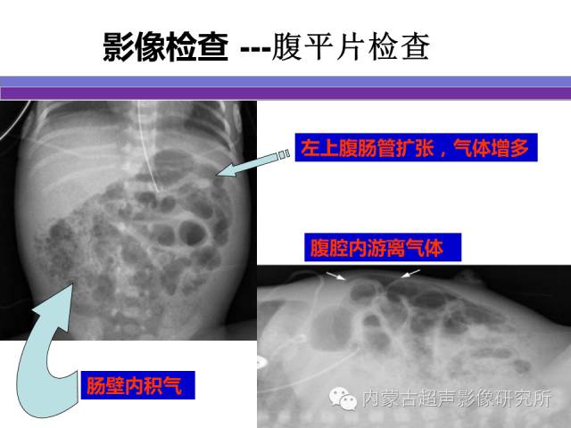影像PPT - 【PPT】坏死性小肠结肠炎-7