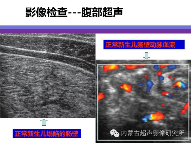 影像PPT - 【PPT】坏死性小肠结肠炎-9