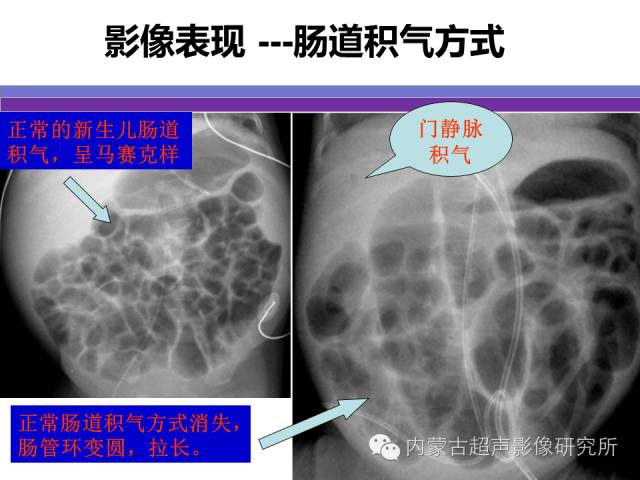 影像PPT - 【PPT】坏死性小肠结肠炎-11