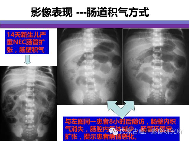 影像PPT - 【PPT】坏死性小肠结肠炎-13