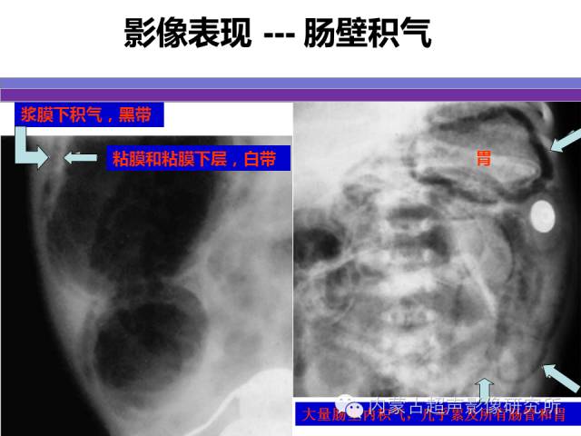 影像PPT - 【PPT】坏死性小肠结肠炎-15