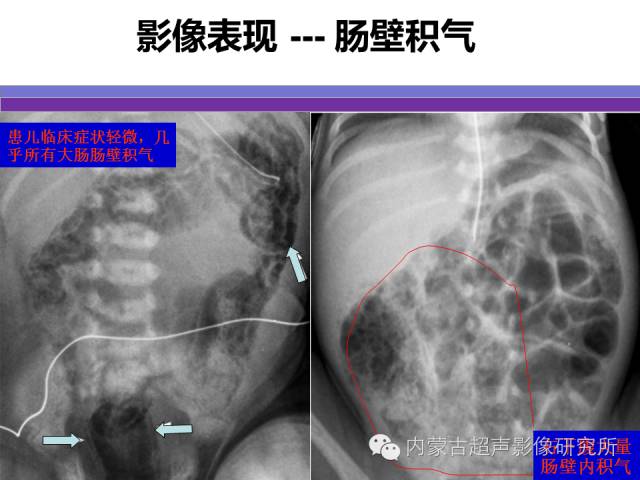 影像PPT - 【PPT】坏死性小肠结肠炎-16