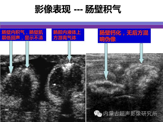 影像PPT - 【PPT】坏死性小肠结肠炎-19