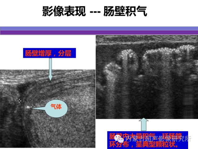 影像PPT - 【PPT】坏死性小肠结肠炎-18