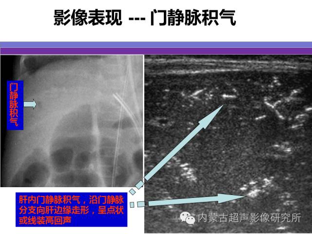 影像PPT - 【PPT】坏死性小肠结肠炎-21