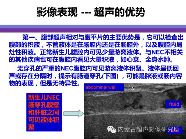 影像PPT - 【PPT】坏死性小肠结肠炎-22