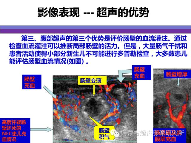 影像PPT - 【PPT】坏死性小肠结肠炎-25