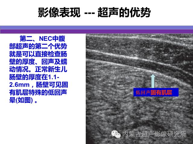 影像PPT - 【PPT】坏死性小肠结肠炎-23
