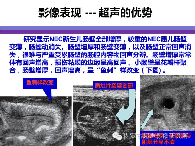 影像PPT - 【PPT】坏死性小肠结肠炎-24
