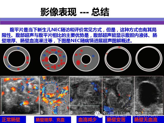 影像PPT - 【PPT】坏死性小肠结肠炎-26